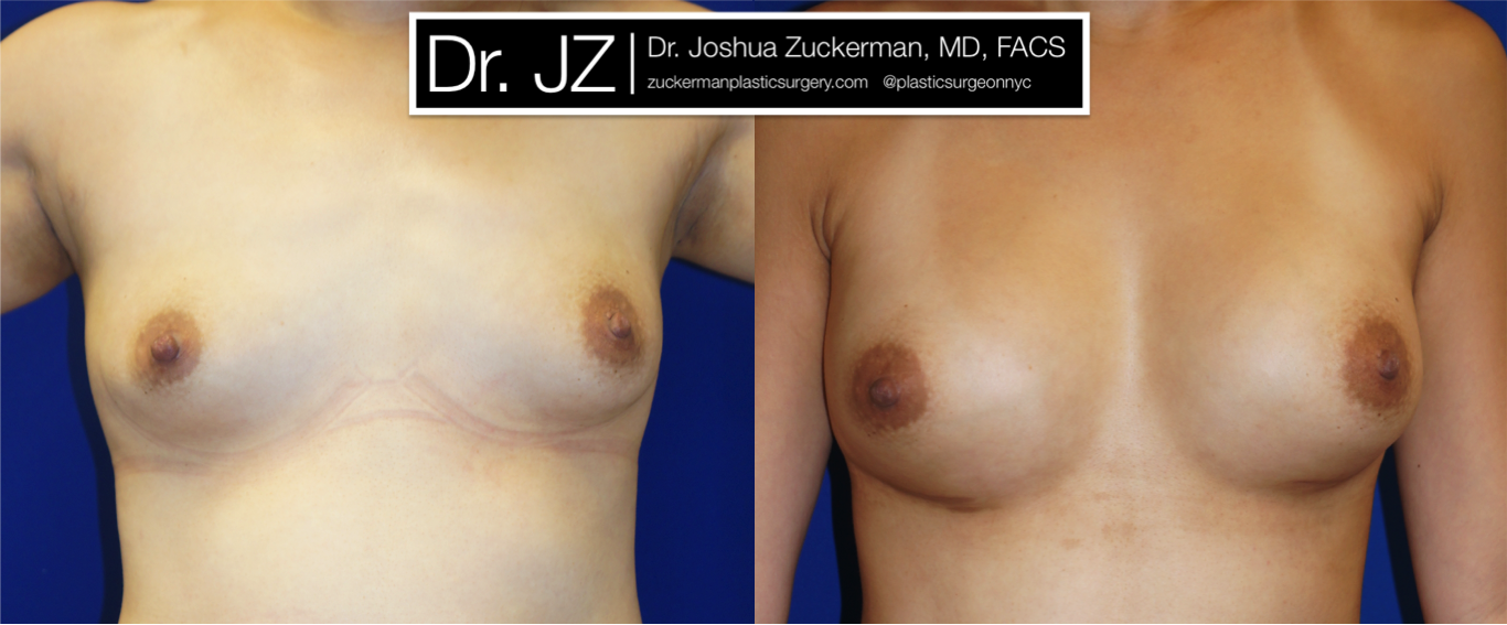 Frontal view of Breast Augmentation patient, female, 1 month post-op. 400cc Mentor Smooth Round silicone breast implants, with submuscular placement.