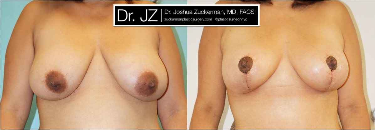 Frontal view of Breast Lift patient, female, 2 months post-op. Scars will continue to fade to a thin, almost invisible, line, with final result at 12mos.