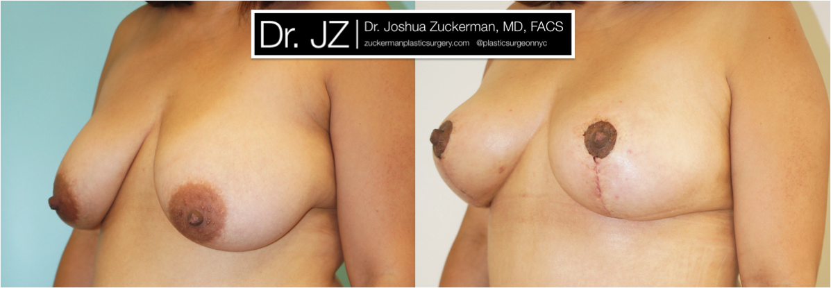 Left oblique view of Breast Lift patient, female, 2 months post-op. Scars will continue to fade to a thin, almost invisible, line, with final result at 12mos.