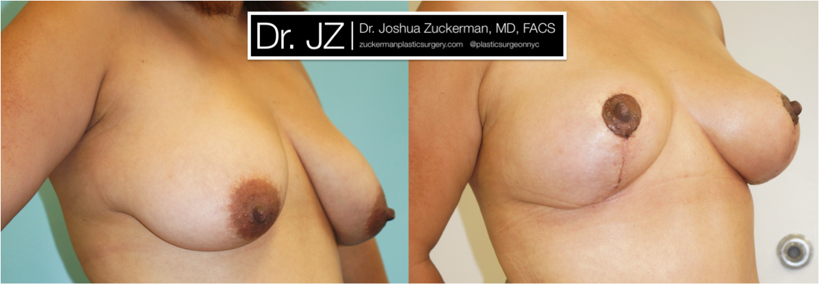 Right oblique view of Breast Lift patient, female, 2 months post-op. Scars will continue to fade to a thin, almost invisible, line, with final result at 12mos.