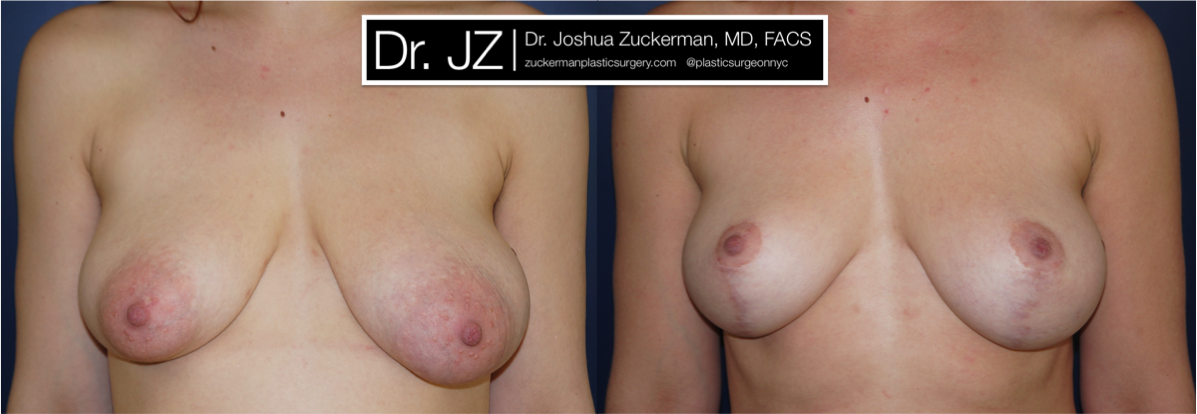 Frontal view of Breast Lift patient, female, 2 years post-op. Reduced left-side breast asymmetry.