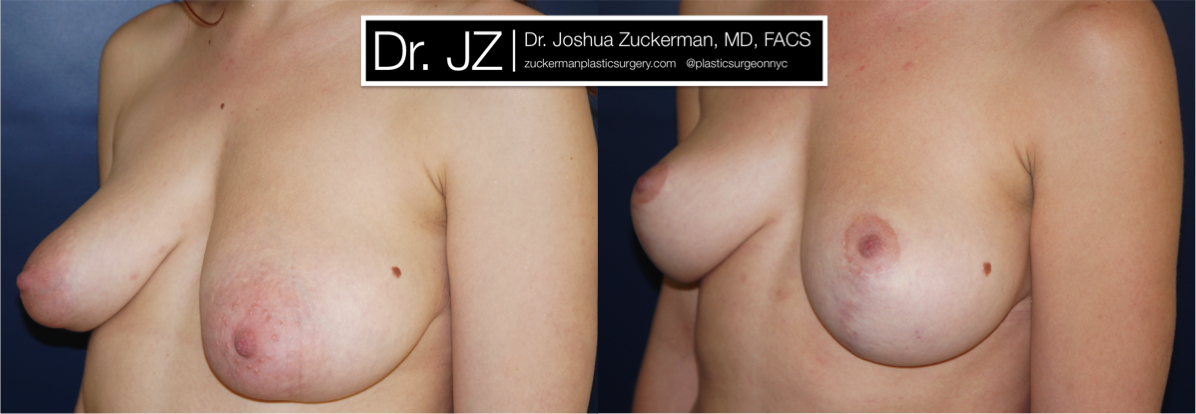 Left oblique view of Breast Lift patient, female, 2 years post-op. Reduced left-side breast asymmetry.