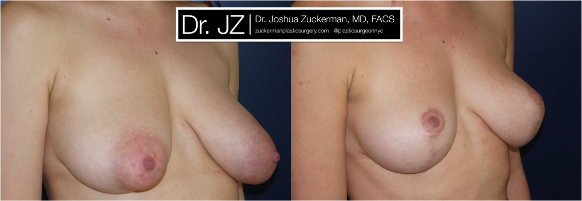 Right oblique view of Breast Lift patient, female, 2 years post-op. Reduced left-side breast asymmetry.