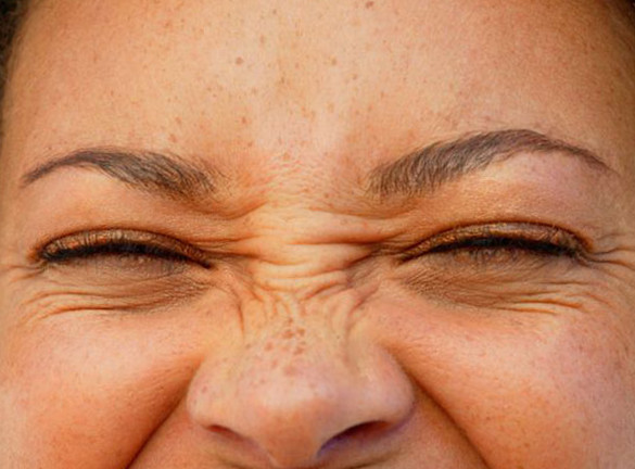 Example of the facial expression that causes bunny lines in some people. Bunny lines can be treated by Dr. Zuckerman with Botox Cosmetic in his office in New York City.
