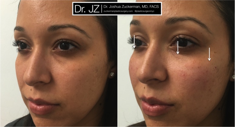 Left oblique view of cheek enhancement patient using Voluma. Restore cheek roundness / youthfulness lost due to flattening and midface descent due to aging. One vial (1cc) injected total. Treatment result is subtle, so arrows are provided.