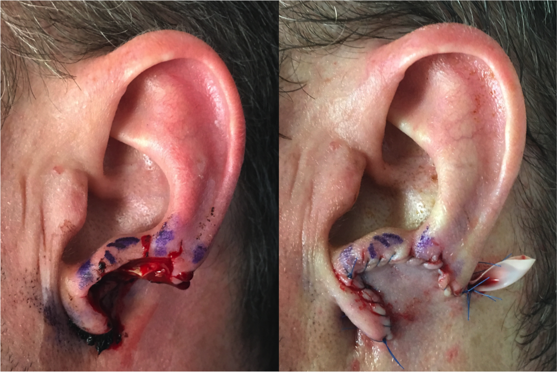 Before & after of the initial stage one of a two-stage ear lobe reconstruction. In initial stage, ear lobe defect is covered with a flap from behind the ear. Six weeks later, the flap will be detached and the ear lobe constructed.