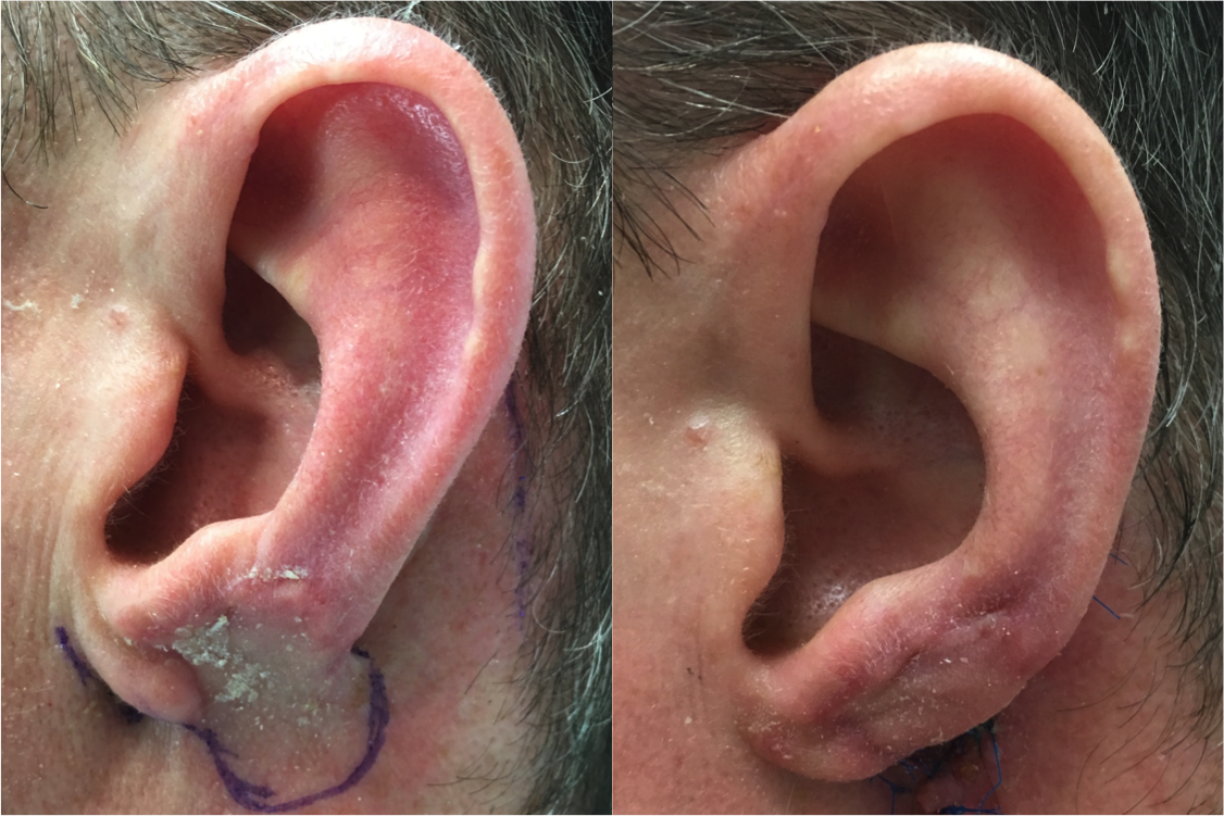 Before & after of stage two of a two-stage ear lobe reconstruction. Six weeks after the initial operation, the flap is detached and the ear lobe constructed. 3 months post-op.