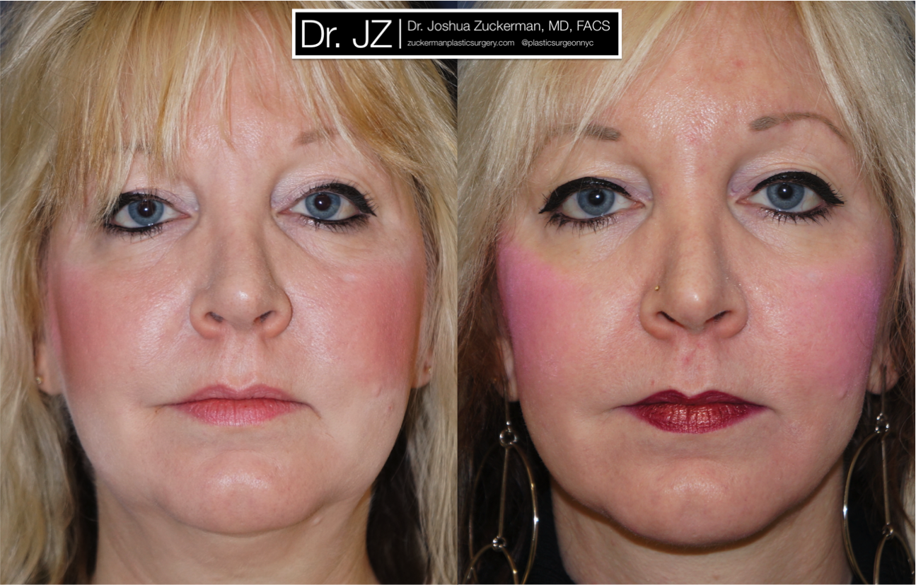 facelift, before and after, 1, frontal, joshua zuckerman, plastic surgery
