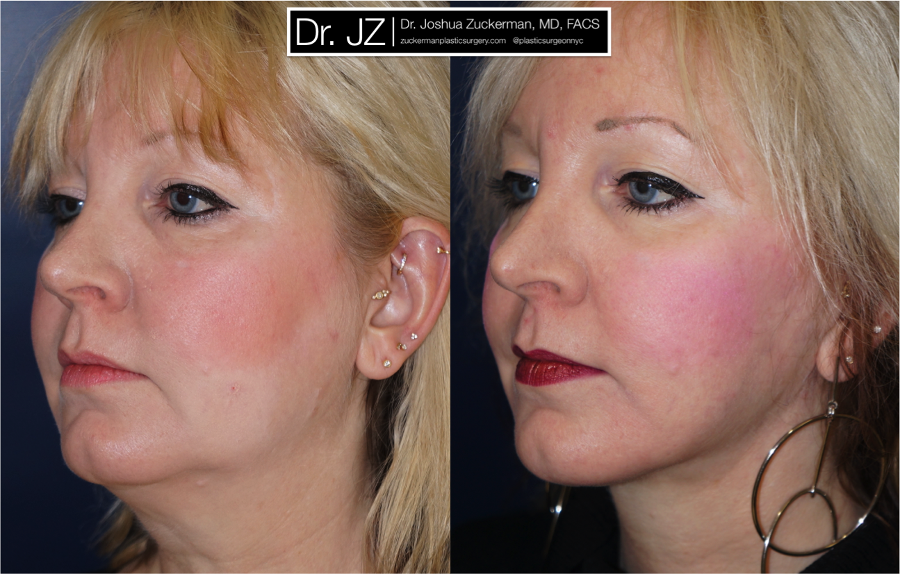 facelift, before and after, 1, left oblique, joshua zuckerman, plastic surgery