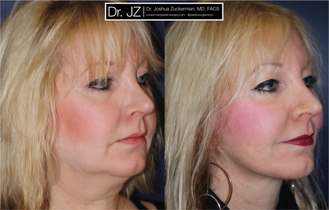facelift, before and after, 1, right oblique, joshua zuckerman, plastic surgery