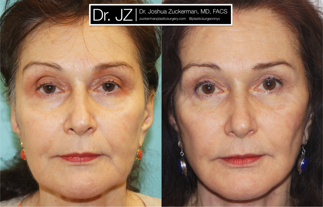 facelift, before and after, 2, right oblique, joshua zuckerman, plastic surgery, frontal