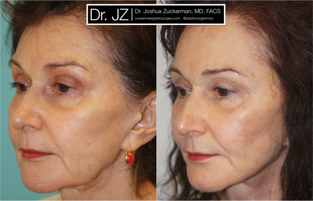 facelift, before and after, 2, right oblique, joshua zuckerman, plastic surgery
