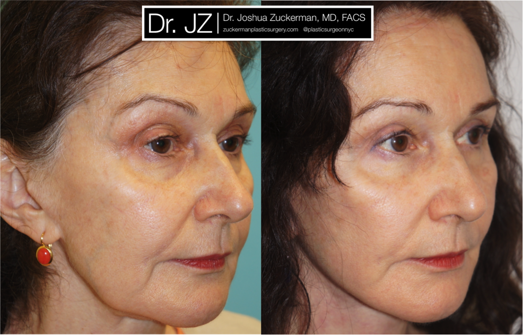 facelift, before and after, 2, right oblique, joshua zuckerman, plastic surgery