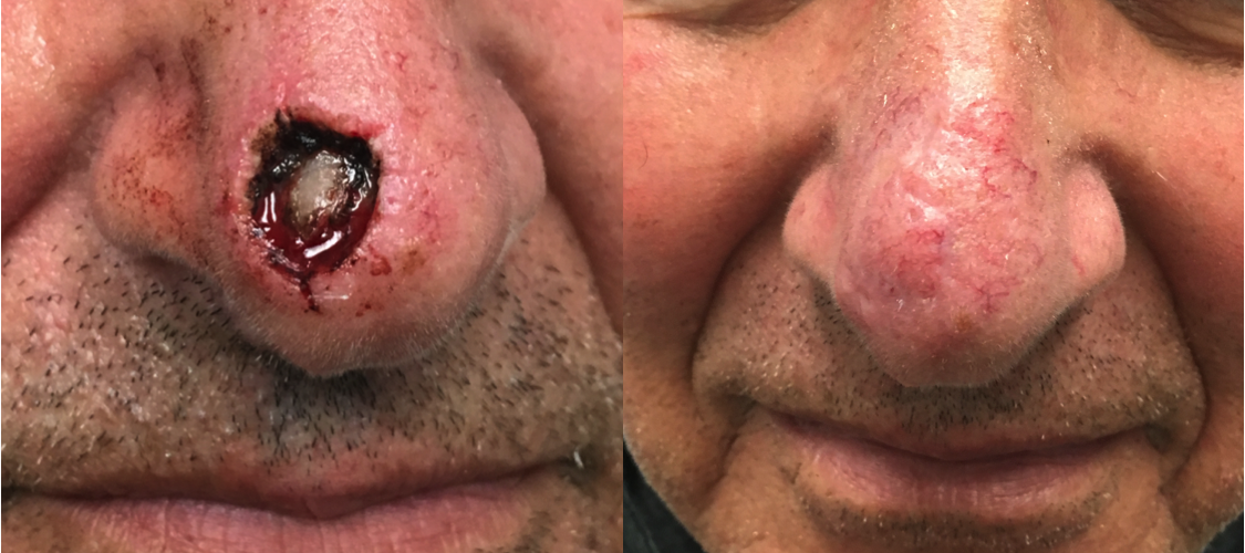 Frontal view of before and after facial reconstruction of a nasal tip defect after Moh's excision of basal cell carcinoma, using bilobe flap. 3 months post-op.