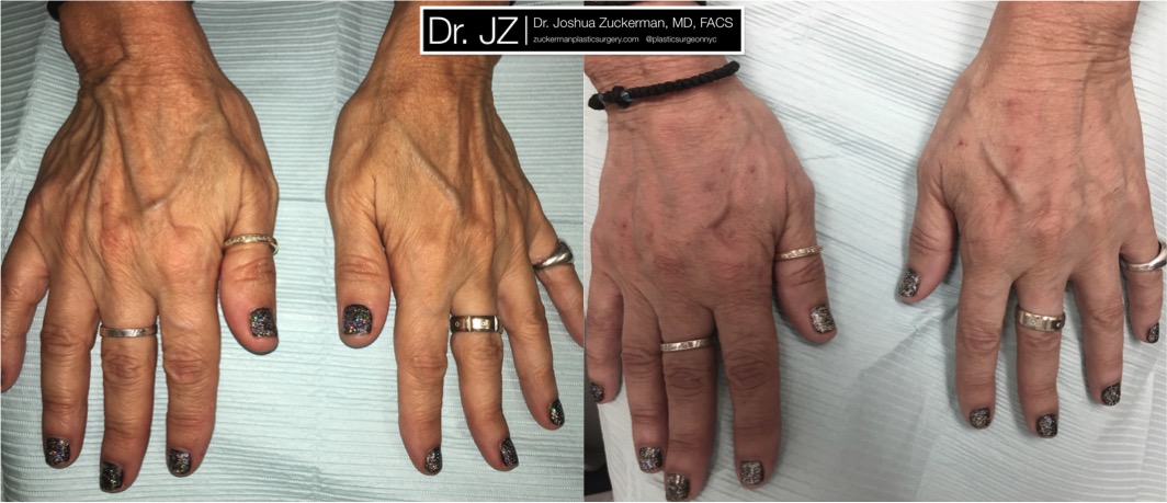 View of hand rejuventation patient. Treatment performed using Radiesse. Reduces the prominence of aging metacarpal bonds, tendons and veins caused by aging. (Note: due to poor photography, light in the after image has been slightly altered to be comparable to the before image.)