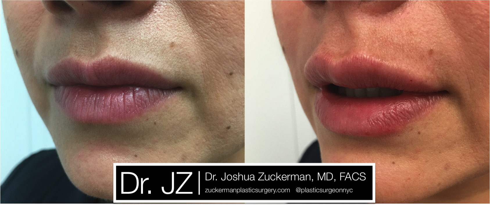 Left oblique view of Lip Augmentation patient, female, day of. Injected 0.7cc of Juvederm Ultra Plus.