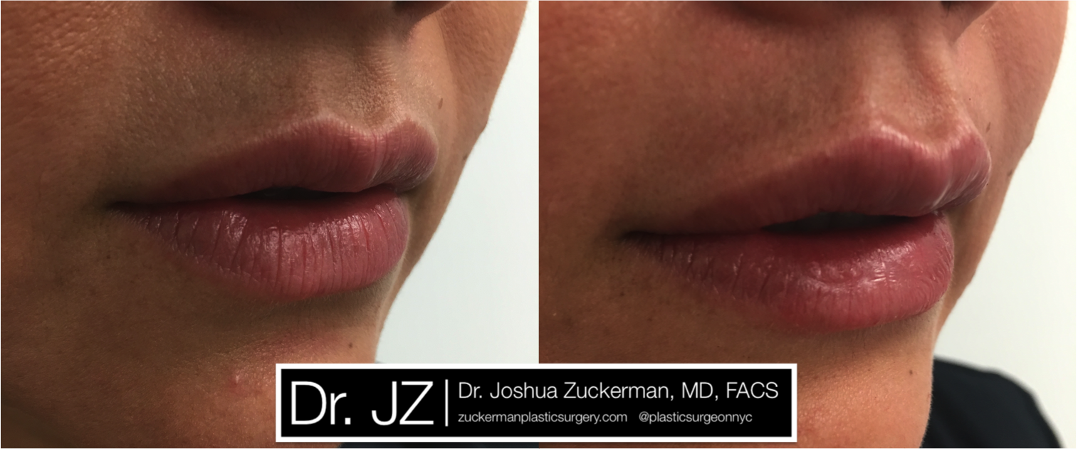 Right oblique view of Lip Augmentation patient, female, day of. Injected 0.7cc of Juvederm Ultra Plus.