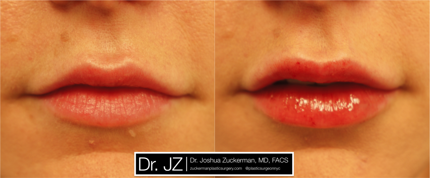 Frontal view of Lip Augmentation patient, female, day of. Injected 0.8cc of Juvederm Ultra Plus.
