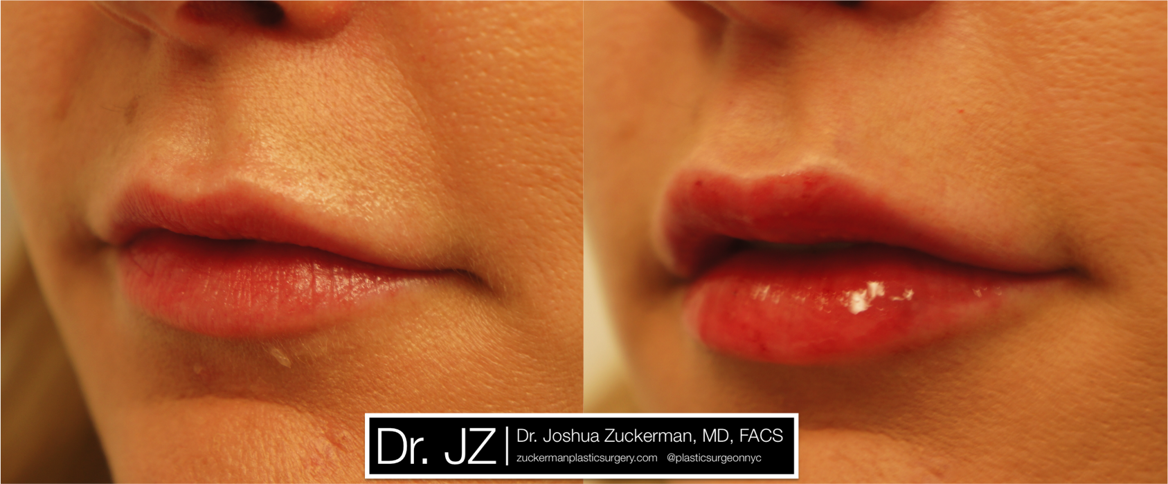 Left oblique view of Lip Augmentation patient, female, day of. Injected 0.8cc of Juvederm Ultra Plus.