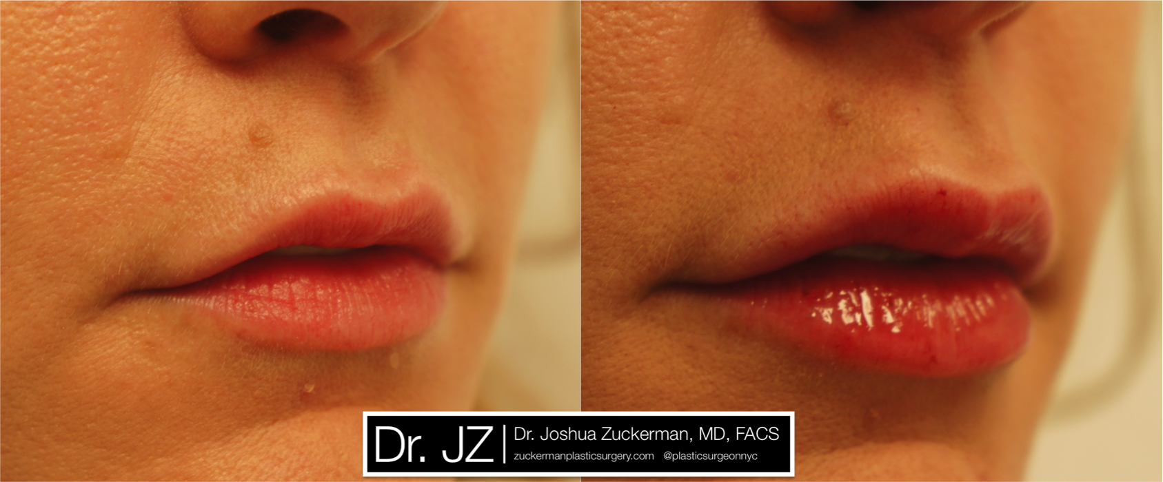 Right oblique view of Lip Augmentation patient, female, day of. Injected 0.8cc of Juvederm Ultra Plus.