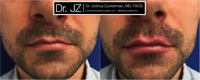 Frontal view of Lip Augmentation patient, male, day of. Injected 0.6cc of Juvederm Ultra Plus. Corrected lip asymmetry of righthand point of Cupid's bow.