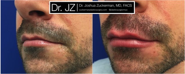 Left oblique view of Lip Augmentation patient, male, day of. Injected 0.6cc of Juvederm Ultra Plus. Corrected lip asymmetry of righthand point of Cupid's bow.