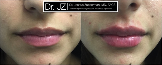 Frontal view of Lip Augmentation patient, female, day of. Injected 0.7cc of Juvederm Ultra Plus for suble lip augmentation, accentuated philtral columns.