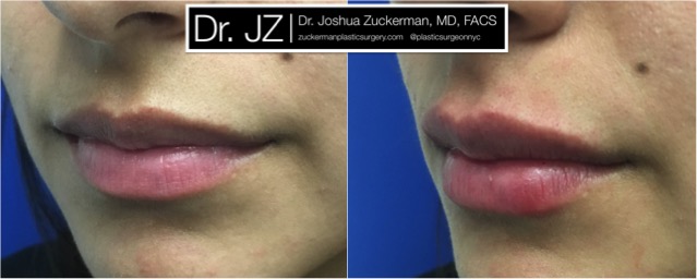 Left oblique view of Lip Augmentation patient, female, day of. Injected 0.7cc of Juvederm Ultra Plus for suble lip augmentation, accentuated philtral columns.