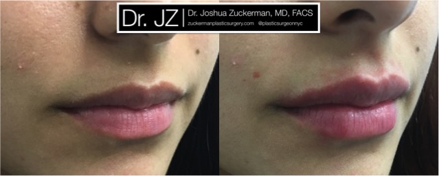 Right oblique view of Lip Augmentation patient, female, day of. Injected 0.7cc of Juvederm Ultra Plus for suble lip augmentation, accentuated philtral columns.