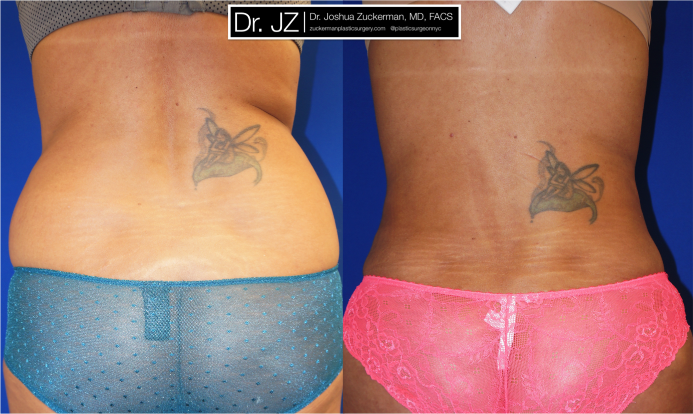 liposuction, abdomen, flanks, lower back, posterior, 4, joshua zuckerman md, nyc