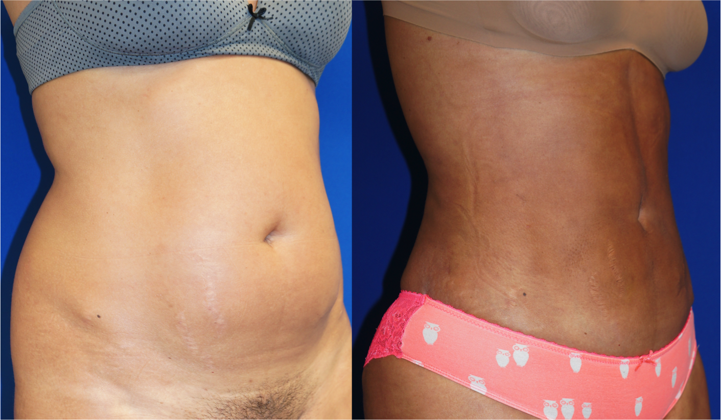 liposuction, abdomen, flanks, lower back, right oblique, 4, joshua zuckerman md, nyc