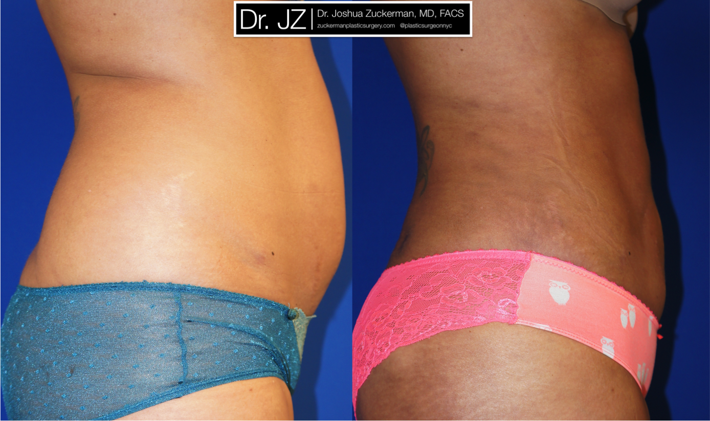liposuction, abdomen, flanks, lower back, right profile, 4, joshua zuckerman md, nyc