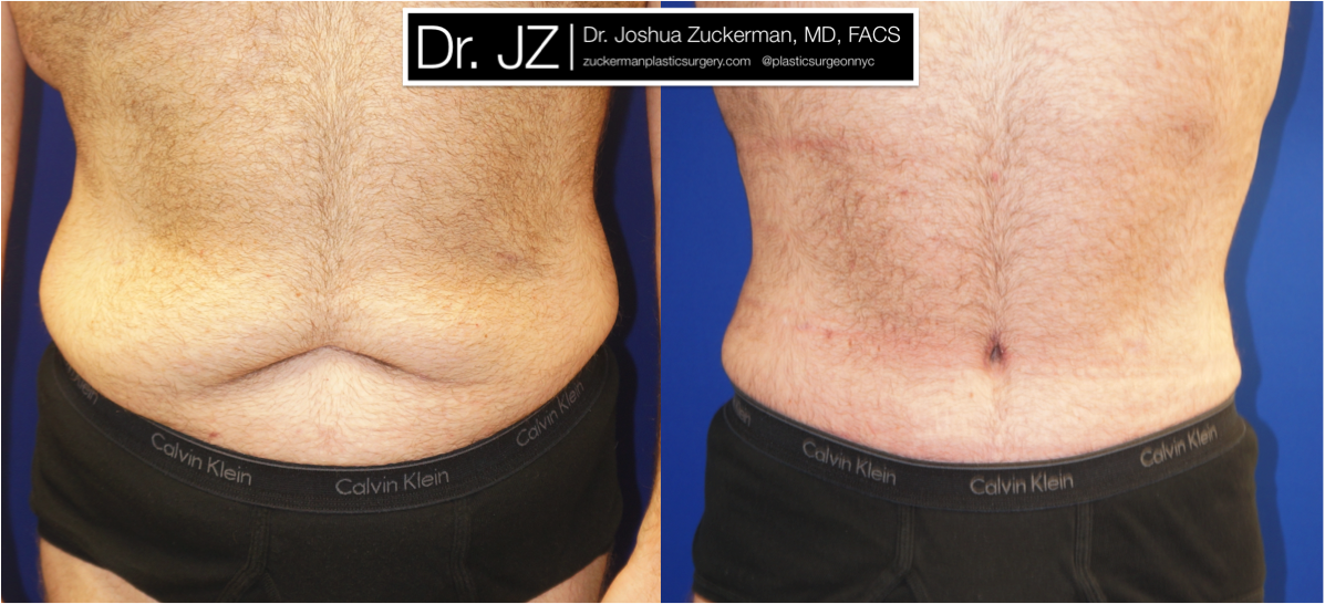 Frontal view of Abdominoplasty (Tummy Tuck) / Post-weight loss patient, male, 2 months post-op. Patient had lost 100 lbs prior to surgery.