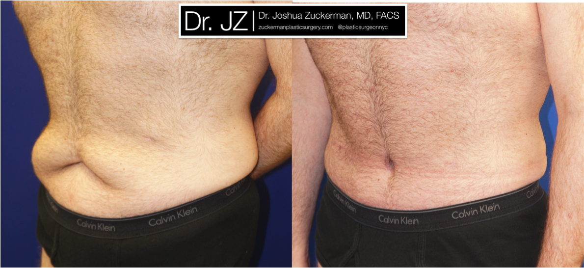 Left oblique view ofAbdominoplasty (Tummy Tuck) / Post-weight loss patient, male, 2 months post-op. Patient had lost 100 lbs prior to surgery.