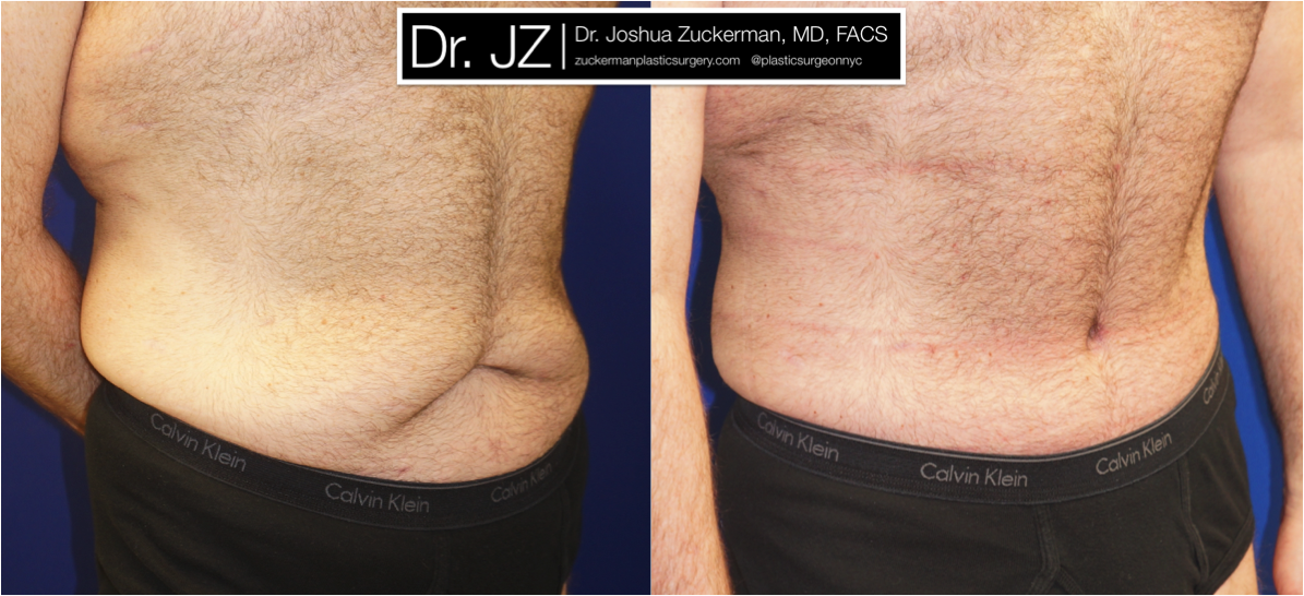 Right oblique view ofAbdominoplasty (Tummy Tuck) / Post-weight loss patient, male, 2 months post-op. Patient had lost 100 lbs prior to surgery.