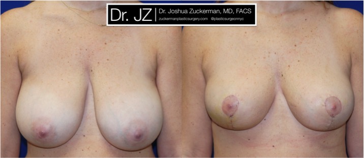 Frontal view of Breast reduction patient, female, 3 weeks post-op. Vertical breast reduction. Post-operative bruising will subside and incisions heal to thin line.