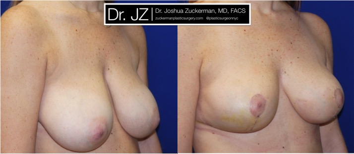 Right oblique view of Breast reduction patient, female, 3 weeks post-op. Vertical breast reduction. Post-operative bruising will subside and incisions heal to thin line.