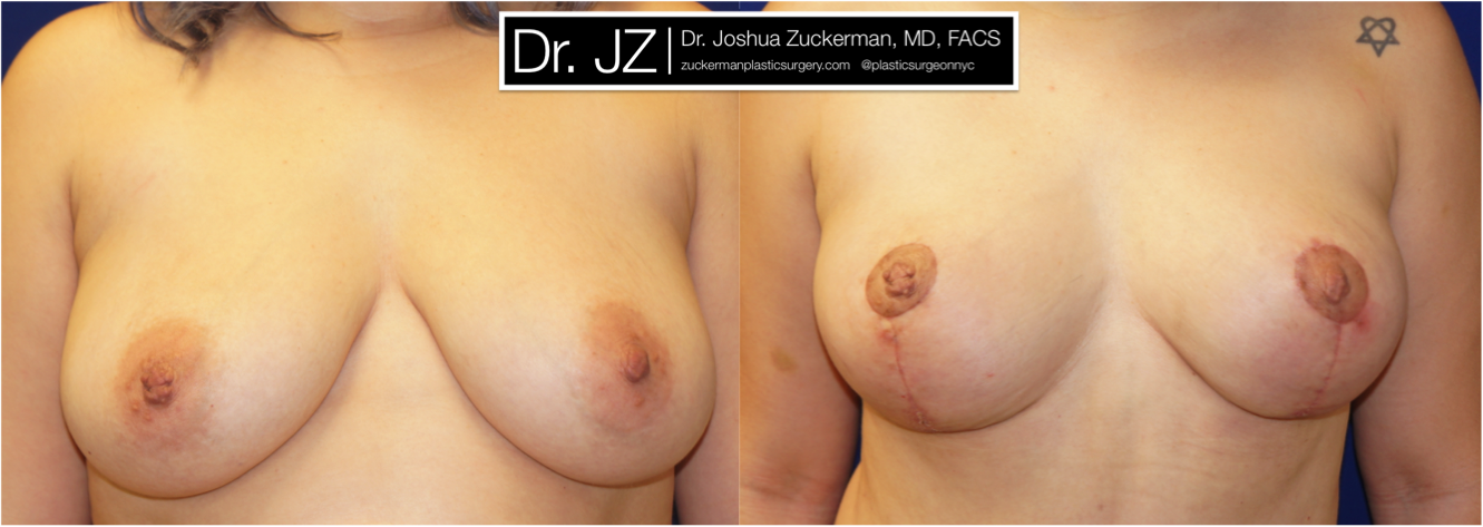 Frontal view of Breast Lift patient, female, 1.5 months post-op. Scars will continue to fade to a thin, almost invisible, line, with final result at 12mos.