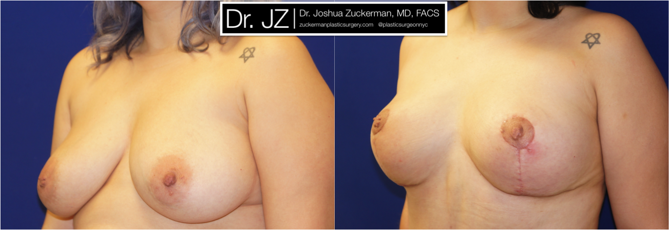 Left oblique view of Breast Lift patient, female, 1.5 months post-op. Scars will continue to fade to a thin, almost invisible, line, with final result at 12mos.