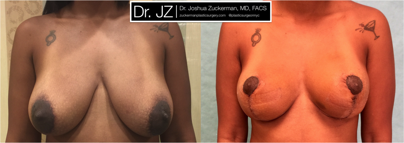 Frontal view of early Breast Lift patient, female, 1 week post-op. Scars will fade to a thin, almost invisible, line, with final result at 12mos.