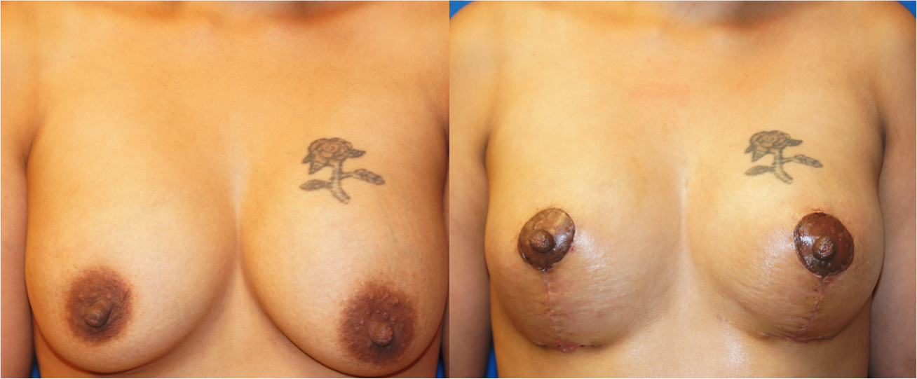 Frontal view of Breast Lift patient, female, 1 month post-op. Mastopexy around existing breast implants. Corrected significant, Grade II, ptosis (sag) of the breasts.