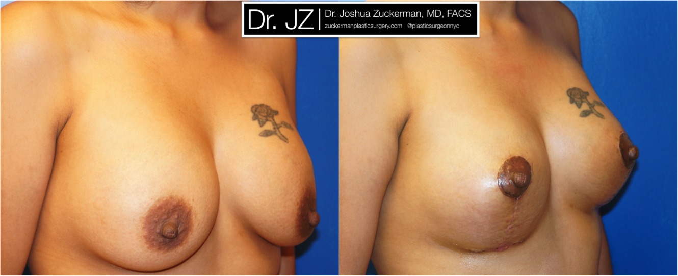 Right oblique view of Breast Lift patient, female, 1 month post-op. Mastopexy around existing breast implants. Corrected significant, Grade II, ptosis (sag) of the breasts.