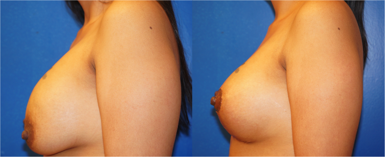Left profile view of Breast Lift patient, female, 1 month post-op. Mastopexy around existing breast implants. Corrected significant, Grade II, ptosis (sag) of the breasts.