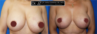 Frontal view of Breast Lift and breast implant removal patient, female, 1 month post-op, vertical breast lift.