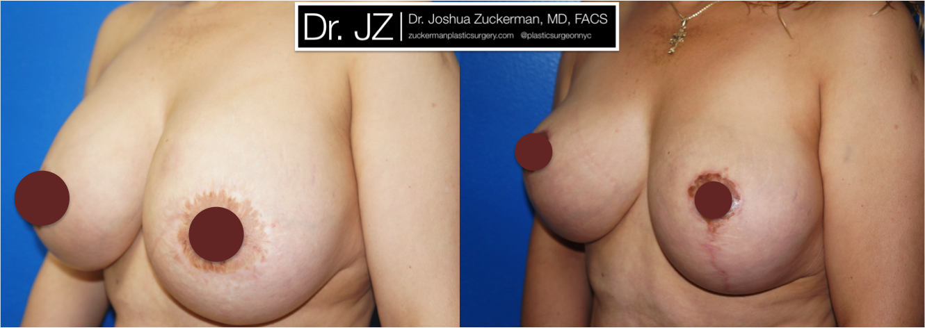 Left oblique view of Breast Lift and breast implant removal patient, female, 1 month post-op, vertical breast lift.