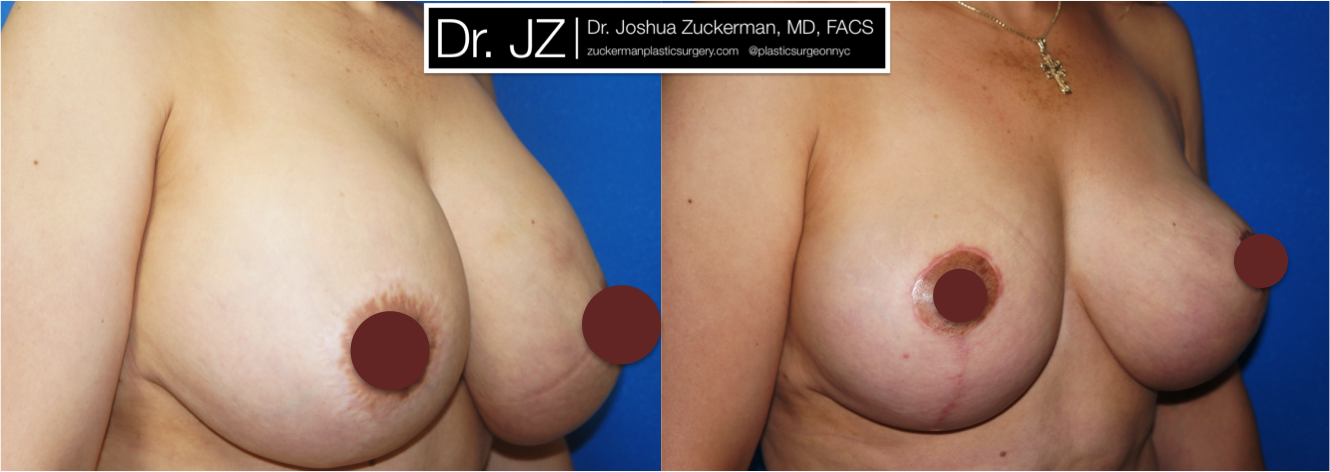 Right oblique view of Breast Lift and breast implant removal patient, female, 1 month post-op, vertical breast lift.