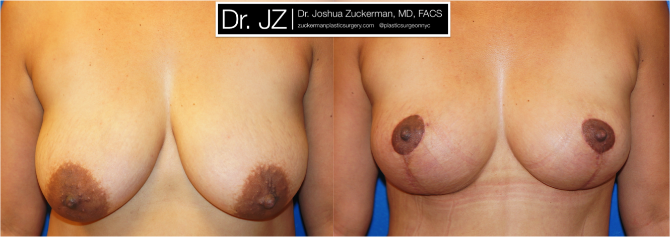 Frontal view of Breast Lift patient, female, 1 month post-op, vertical breast lift.