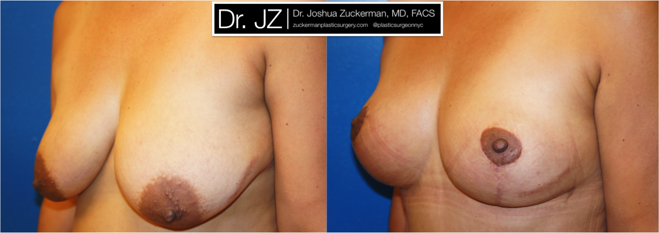 Left oblique view of Breast Lift patient, female, 1 month post-op, vertical breast lift.