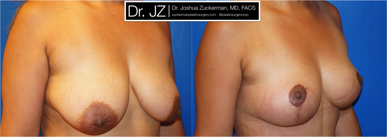 Right oblique view of Breast Lift patient, female, 1 month post-op, vertical breast lift.
