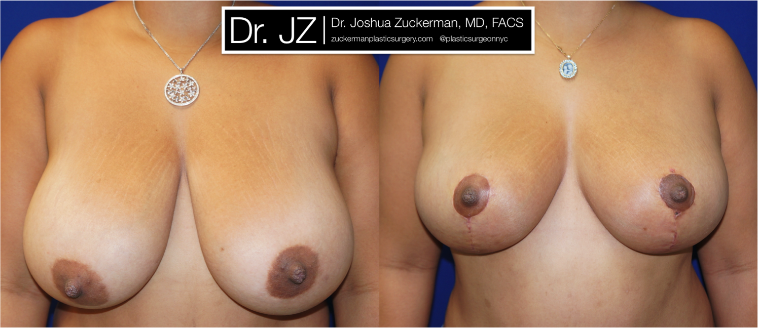 Frontal view of Breast Lift patient, female, 1 month post-op. Vertical breast lift.